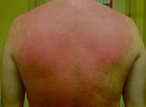 Como sanar al chiquitín de atopicheskogo de la dermatitis